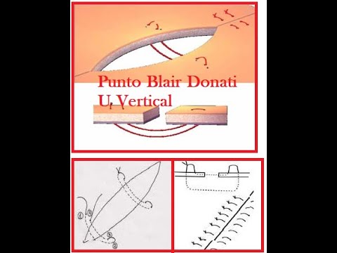 Punto Blair Donati - U Vertical