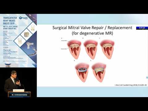 M. Chrissoheris  | Echocardiographic evaluation of the mitral valve. A guide to decision-making f...