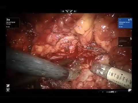 Robotic-Assisted Kidney Removal Due To Complex And Pedicle Lesion