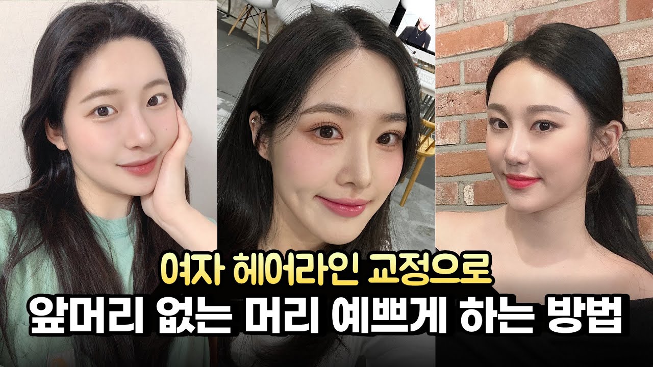  앞머리 없는 예쁜 머리 완성! 헤어라인교정 1년 후기ㅣ1200~1600모낭ㅣ뉴헤어