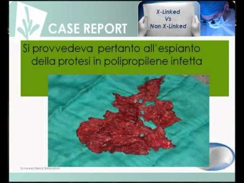 Fare dolore ascella in osteocondrosi Trattamento di Spinale dellIstituto