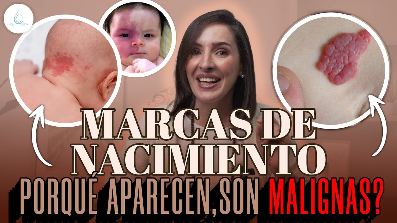 🔴 Birthmarks: Could they be serious? @drapilarochoa - Dermatologist