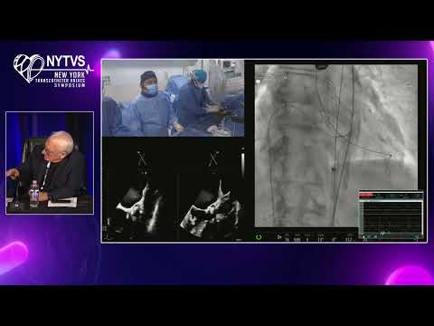 LIVE CASE 3 - Redo-TAVR using SAPIEN-3 Ultra Resilia