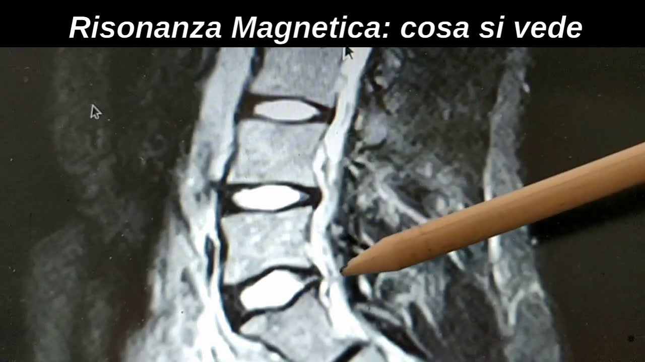 Risonanza Magnetica: cosa si vede
