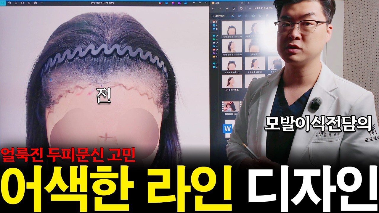 30대여성헤어라인, 두피문신 흔적과 넓은 이마를 고려한 3915모 여성대량이식 계획