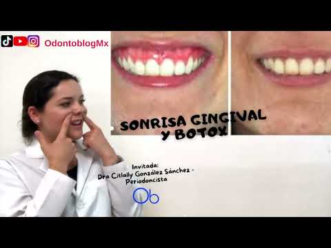Sonrisa gingival y botox