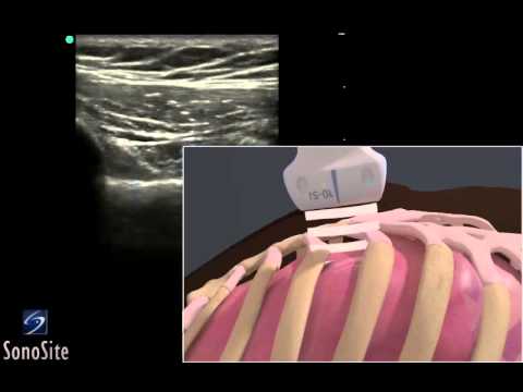 3D How to: EFAST - Lung Sliding Detection with Linear Transducer
