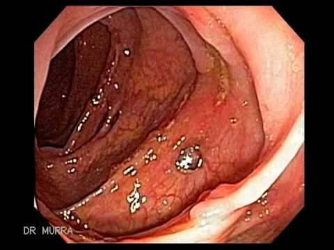 download lagu mp3 mp4 Crohn Betegsg, download mp3 Crohn Betegsg free download, download mp3 Crohn Betegsg