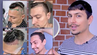 Implante Capilar Evolução Mês a Mês (bônus no final)