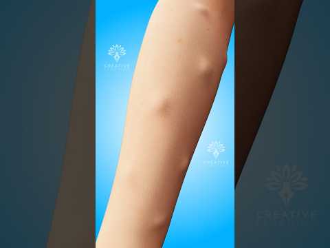 Warum bilden sich Lipome unter der Haut? #shorts #viralvideo #lipome - Creativelearning3d