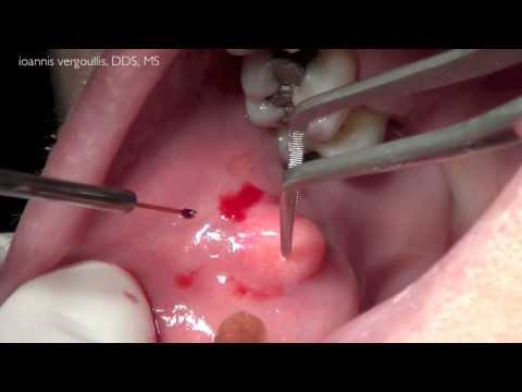 könyökízület fibroma kezelése ízületek és gerinc fájdalma és ropogása