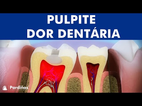 Pulpite – Inflamação da polpa dentária ©