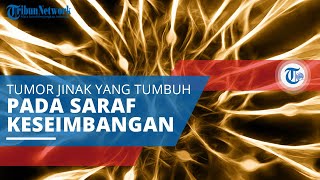 Neuroma Akustik, Tumor Jinak yang Tumbuh pada Saraf yang Hubungkan Bagian Dalam Telinga dengan Otak