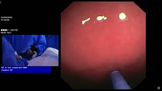 Endoscopic Sleeve Gastrectomy (ESG):Successful operation under the supervision of expert surgeons..