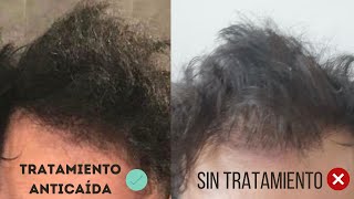 CASO REAL: ¿QUÉ OCURRE SI DEJAS LA MEDICACIÓN TRAS UN TRASPLANTE