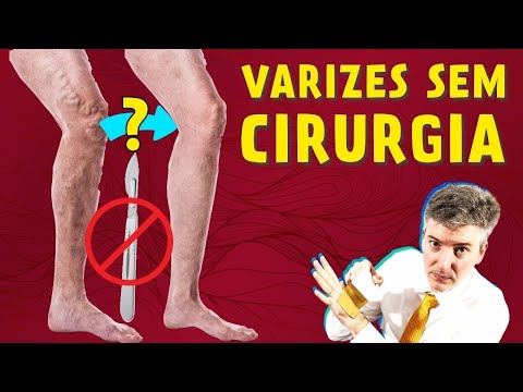 VARIZES: o Que São e Como Tratá-las SEM CIRURGIA com o Dr. Alexandre Amato