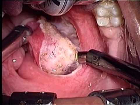 Tonsillectomy Surgery