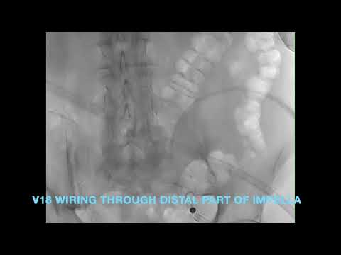Combined Impella RP System assistance plus TricValve implant