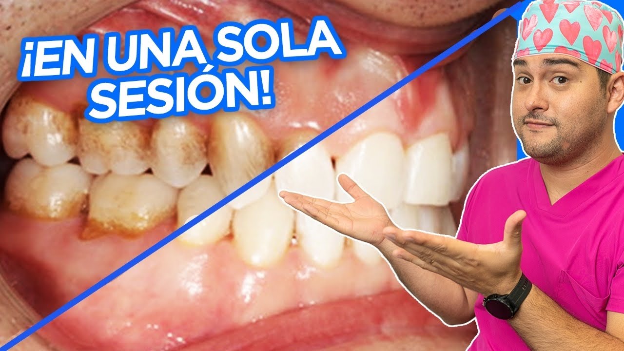 Watch ALIMENTOS QUE MÁS MANCHAN TUS DIENTES 🦷 Y ¿POR QUE🔥 NO SON LOS QUE CREES ¡de AMARILLOS a BLANCOS! Now ALIMENTOS QUE MÁS MANCHAN TUS DIENTES 🦷 Y ¿POR QUE🔥 NO SON LOS QUE CREES ¡de AMARILLOS a BLANCOS!