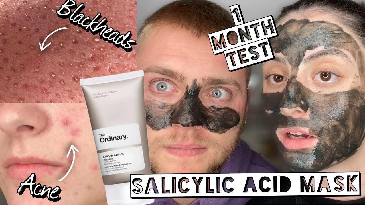 TESTING THE ORDINARY SALICYLIC ACID MASQUE ON ACNE & BLACKHEADS FOR 1 MONTH Ft. My Boyfriend