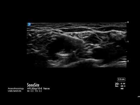 Superior trunk block for awake shoulder surgery. Sala-Blach approach. Regional anesthesia Ultrasound