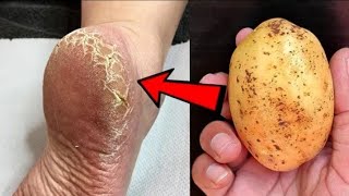 eliminate cracked heels and get white smooth feet / cracked heels home remedy
