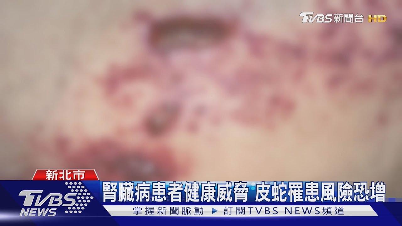 腎臟病患者健康威脅 皮蛇罹患風險恐增