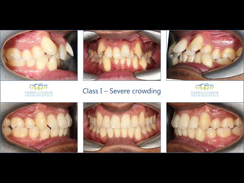 Class I occlusion & Severe Crowding - Removal of four premolar teeth & Labial ceramic braces