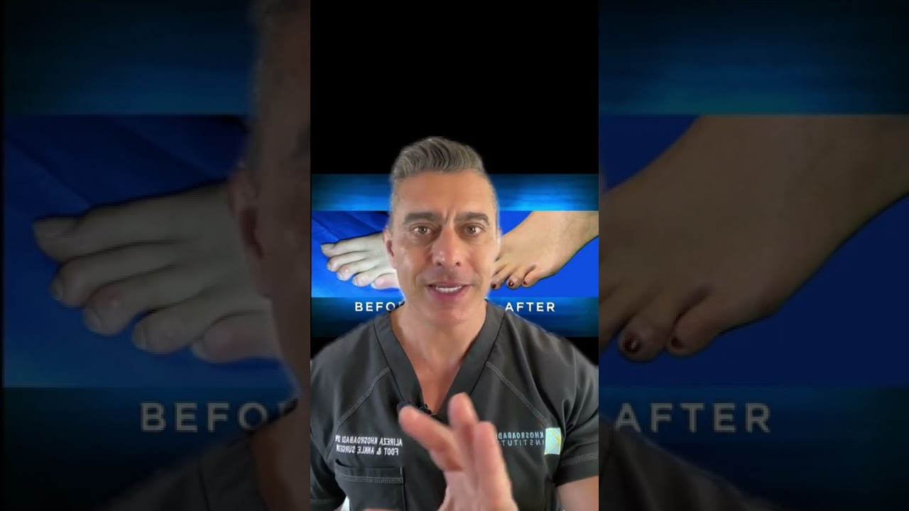 Minimally Invasive Hammertoe Correction