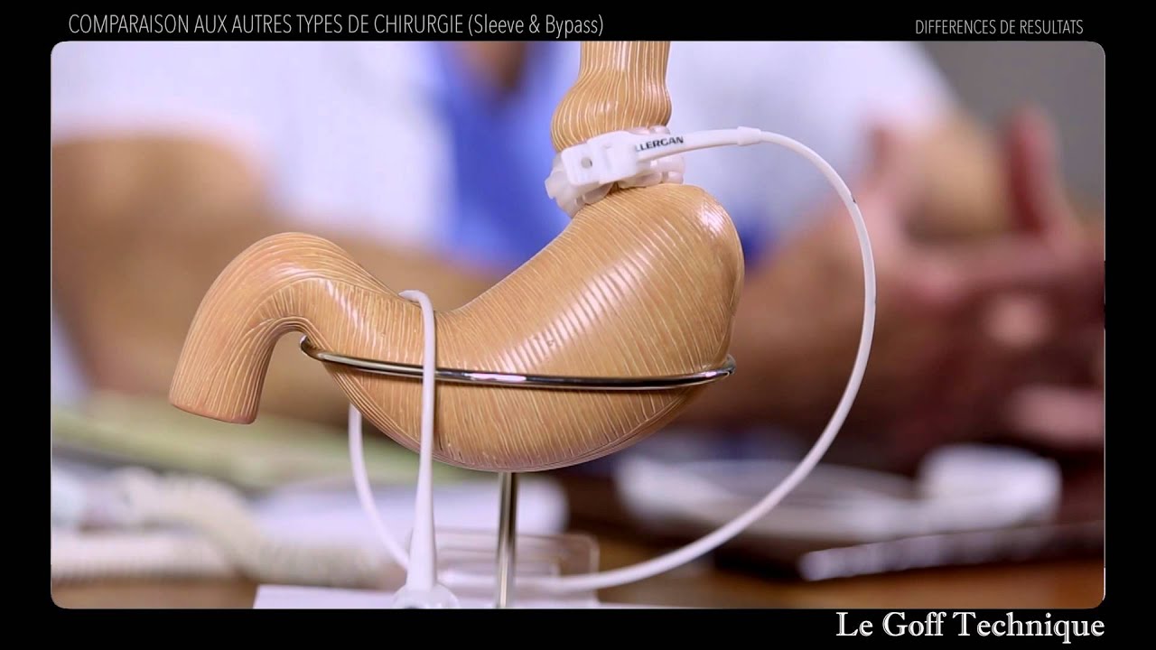 RÉSULTATS : Comparaison avec le Sleeve/Bypass