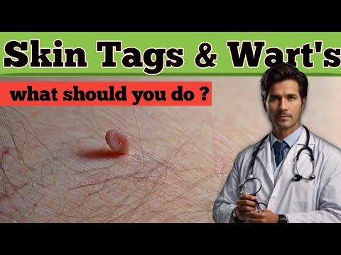 Erase Skin Tags & Warts Fast with Iodine: The Natural Remedy You Need!" #skincare