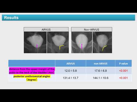 #23082 Effect of advanced reconstruction of vesicourethral support for robot-assisted radical pr...