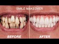 Before & After Smile Makeover Transformations | Cosmetic Dentistry Dental Boutique