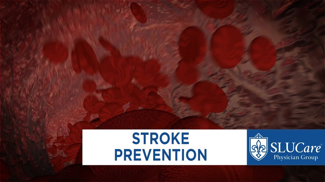 Stroke Prevention - SLUCare Vascular Surgery