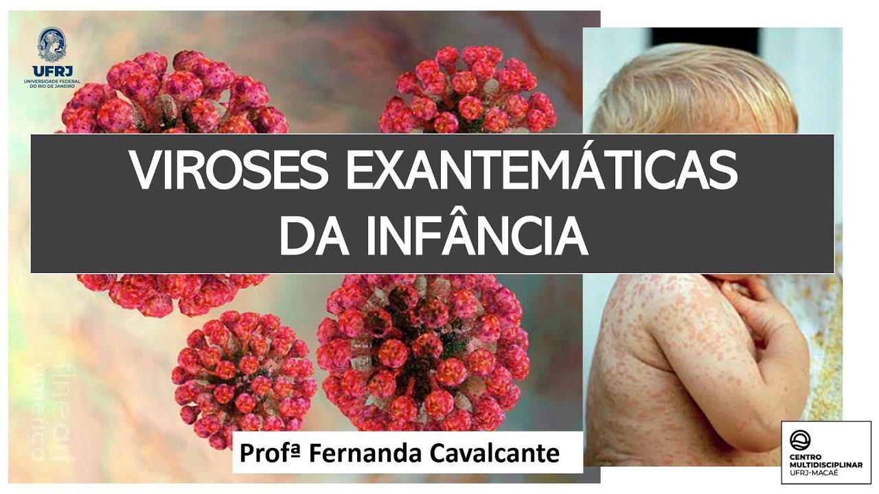 Aula - Viroses Exantemáticas da Infância - UFRJ Macaé