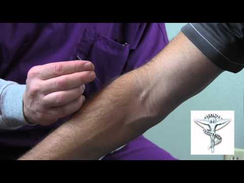 Acupuncture Part II - Springs Chiropractic