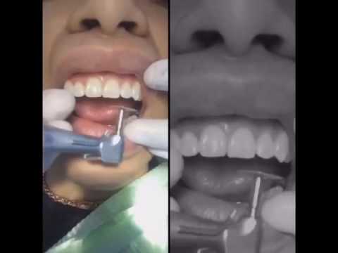 Resina Incisal