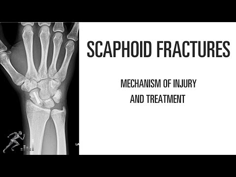 Scaphoid fracture: Mechanism of injury and treatment options of this wrist injury