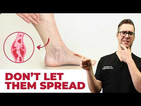 Best Varicose Vein Home Treatments! [Top 25 Spider Veins Remedies]