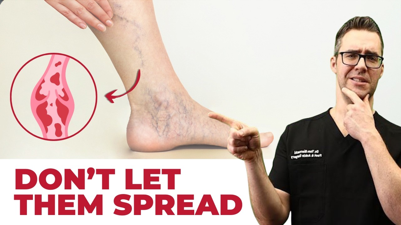 Best Varicose Vein Home Treatments! [Top 25 Spider Veins Remedies]