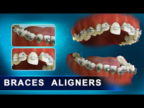 How Braces Aligners work - Elements of the Orthodontic treatment | Advanced 3d Dental Animation