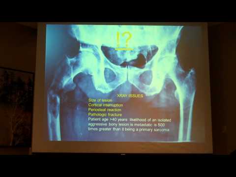 Pathologic Fracture of the Femur from Metastatic Bone Disease