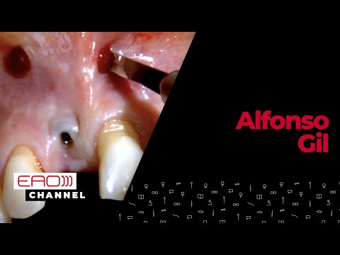 Vista implant mucosal recession coverage