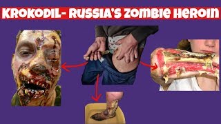 Dangers Of Krokodil- Russia&#39;s Zombie Heroin (AKA Desomorphine)