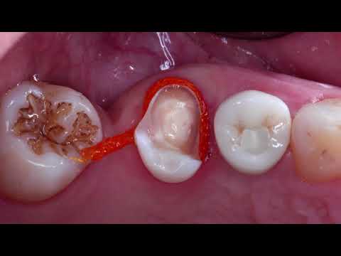 Odbudowa zębów bocznych 