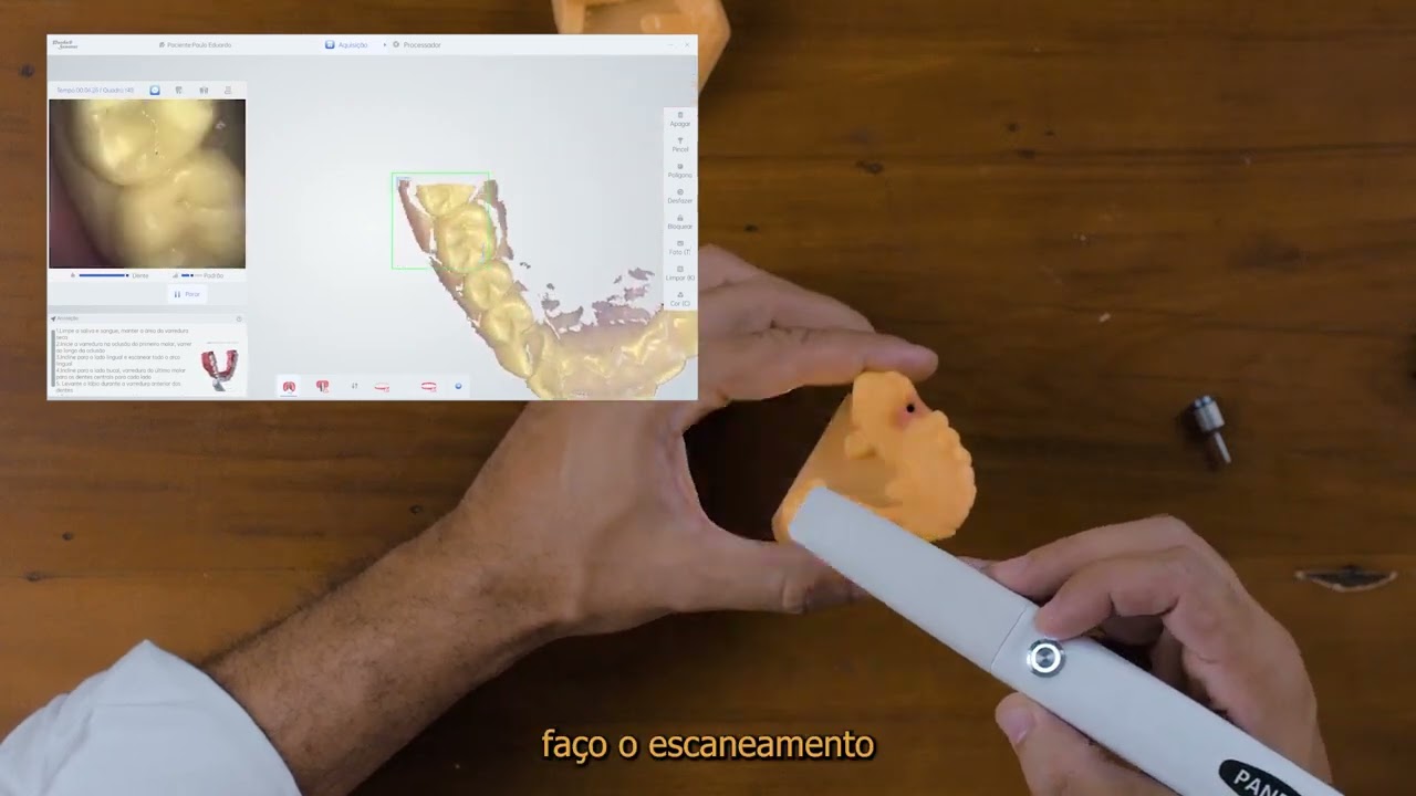 Vídeo 10 - Escaneamento para Implante Unitário