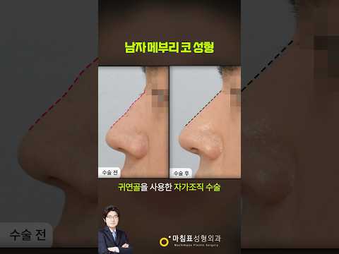 남자 메부리코 수술 · Korean