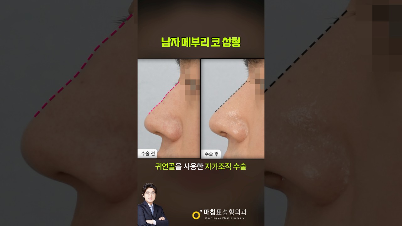 남자 메부리코 수술 썸네일 — 마침표성형외과 눈성형 영상