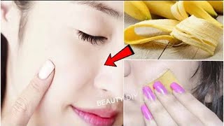Banana Peel Rubbed On My Skin And See The Magical Result │ Remove Pimples, Dark Spots &amp; Whiten Skin