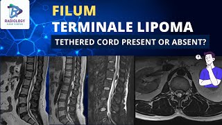 Filum Terminale Lipoma - Tethered Cord Present or Absent?  | Dr. Umamaheswara Reddy .V